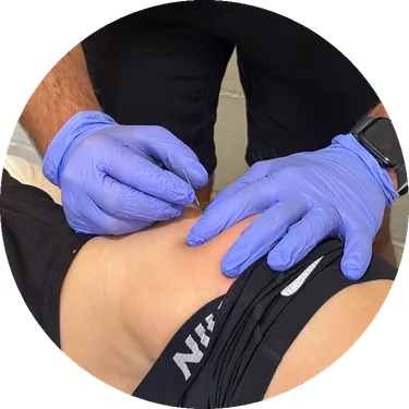 Punción seca con guantes en el glúteo medio de una paciente
